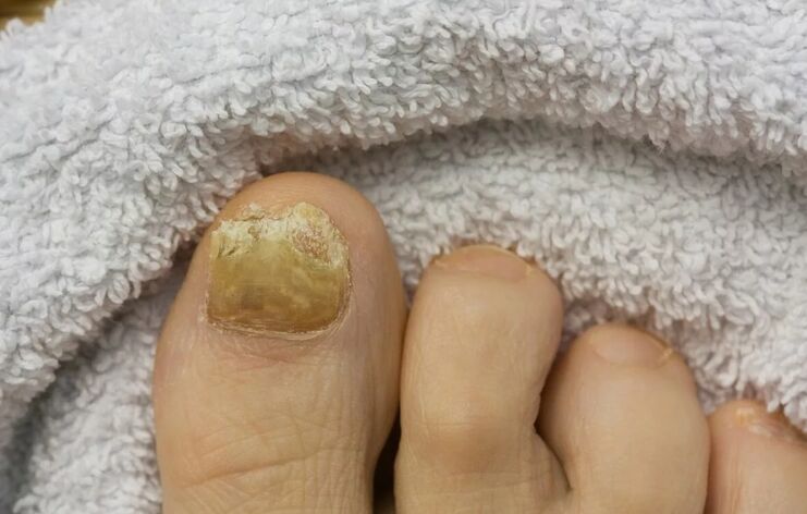 Nail filgus