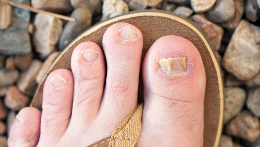 Onychomycosis vun den Nägel